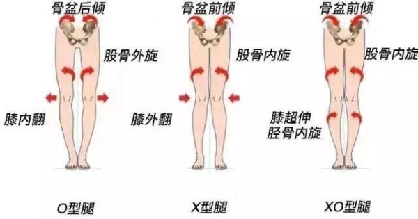 腿型問題