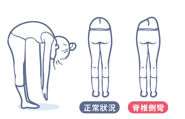 脊柱側彎自測