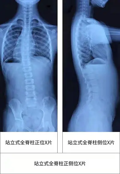 全脊柱正側位x光片