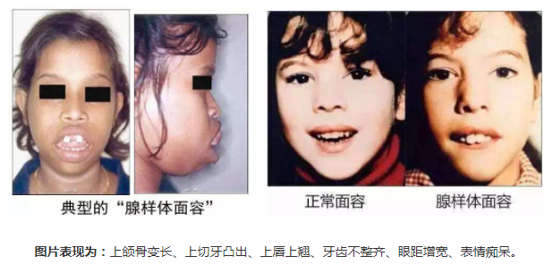 正常面容與腺樣體面容圖片對(duì)比圖