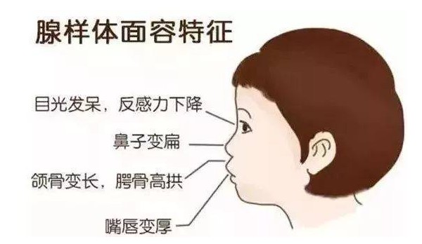 腺樣體面容特征