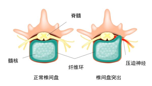 椎間盤突出示意圖