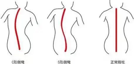 脊柱側彎