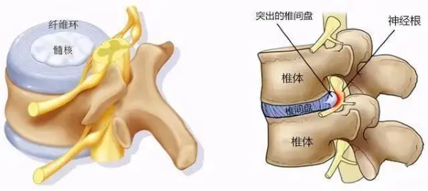 腰椎間盤突出