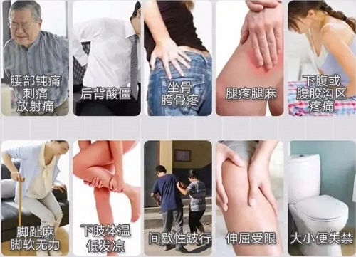 腰突癥狀