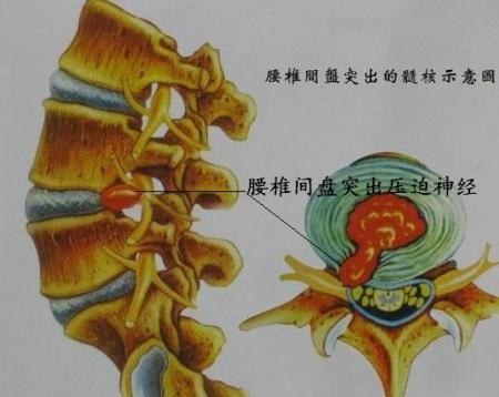 髓核壓迫神經