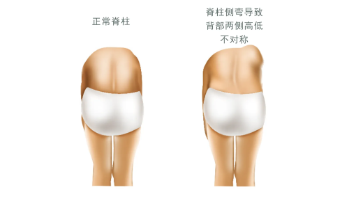 脊柱側(cè)彎對(duì)比圖