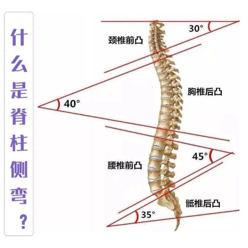 脊柱側(cè)彎