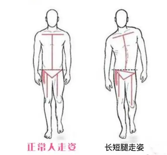 長短腿步態
