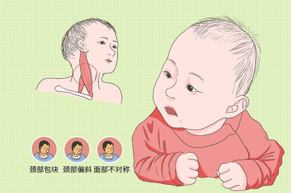 斜頸癥狀