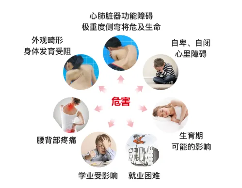 脊柱側彎危害