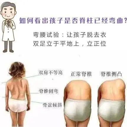 怎么看脊柱彎曲
