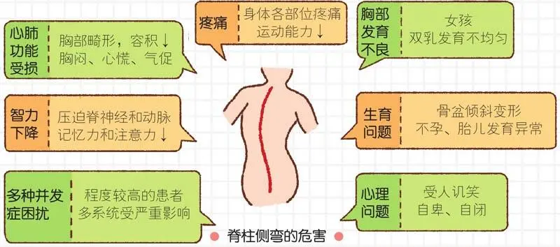 脊柱側彎危害