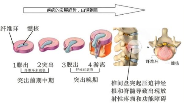 椎間盤突出疾病發展
